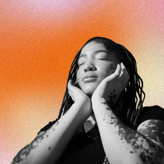 photo of a young woman with vitiligo embracing her unique skin